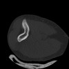 SPORK, NICO - 22.03.1976 - 02.08.2022 - CT obere Extremität - 17:51:17